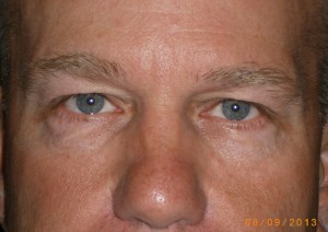 Male Eyelid Surgery