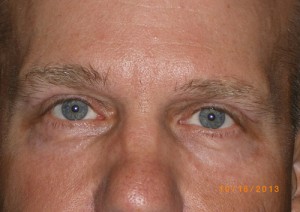 Male Eyelid Surgery