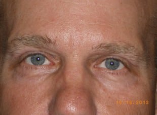 Patient 45 - After View 