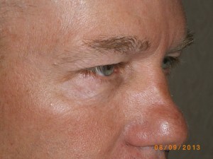 Male Eyelid Surgery