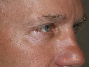 Male Eyelid Surgery