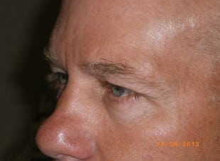 Patient 45 - Before View 