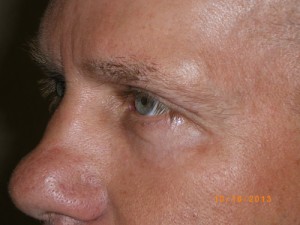 Male Eyelid Surgery