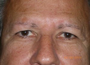 Male Eyelid Surgery