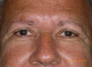 Patient 49 - After View 