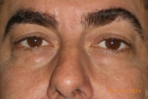 Male Eyelid Surgery