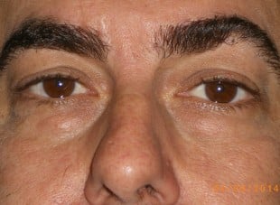 Patient 54 - Before View 