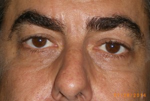 Male Eyelid Surgery