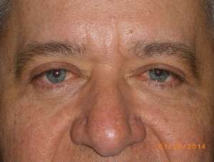 Male Eyelid Surgery