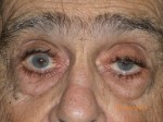 Male Eyelid Surgery