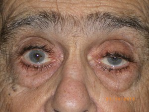 Male Eyelid Surgery