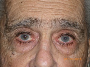 Male Eyelid Surgery