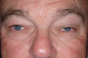 Male Eyelid Surgery