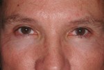 Male Eyelid Surgery