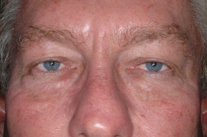 Male Eyelid Surgery