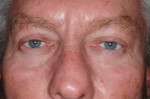 Male Eyelid Surgery