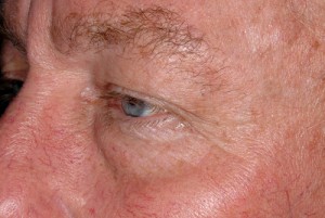 Male Eyelid Surgery