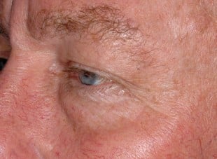 Patient 80 - Before View 