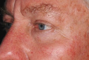 Male Eyelid Surgery