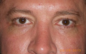 Male Eyelid Surgery