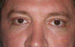 Male Eyelid Surgery