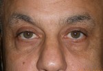 Male Eyelid Surgery