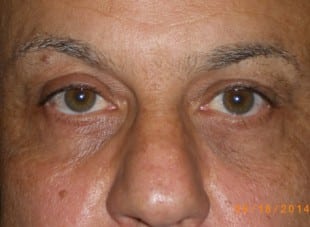 Patient 87 - After View 