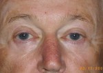 Male Eyelid Surgery