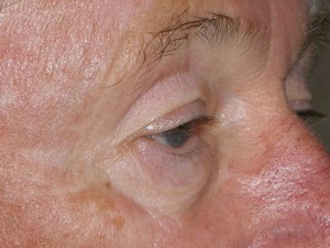 Male Eyelid Surgery