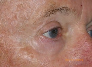 Patient 90 - After View 