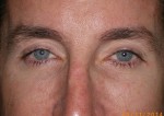 Male Eyelid Surgery