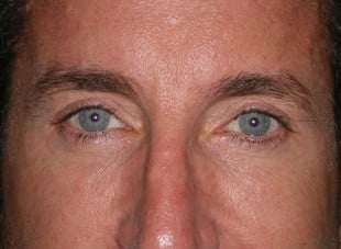 Patient 97 - After View 
