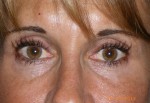 Upper Eyelid Blepharoplasty with Lower Eyelid Laser Resurfacing