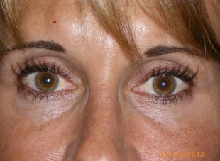 Patient 30 - After View 