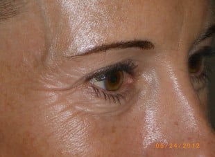 Patient 30 - Before View 