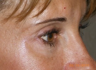 Patient 30 - After View 