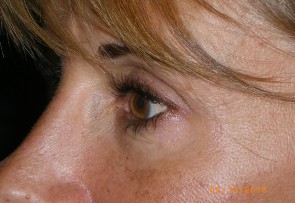 Upper Eyelid Blepharoplasty with Lower Eyelid Laser Resurfacing