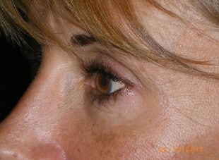 Patient 30 - After View 