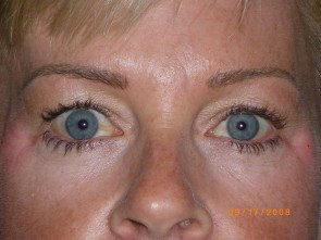 Upper Eyelid Blepharoplasty with Lower Eyelid Laser Resurfacing