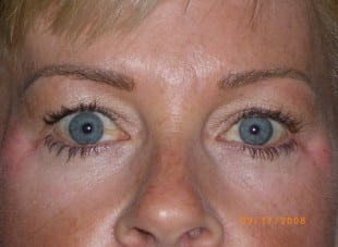 Patient 41 - Before View 