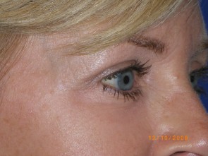 Upper Eyelid Blepharoplasty with Lower Eyelid Laser Resurfacing