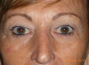 Patient 52 - Before View 