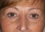 Upper Eyelid Blepharoplasty with Lower Eyelid Laser Resurfacing