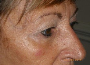 Upper Eyelid Blepharoplasty with Lower Eyelid Laser Resurfacing