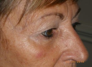 Patient 52 - Before View 