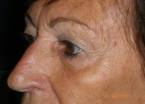 Upper Eyelid Blepharoplasty with Lower Eyelid Laser Resurfacing