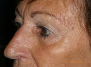 Patient 52 - Before View 