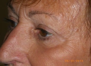 Patient 52 - After View 