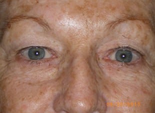 Patient 56 - Before View 