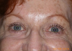 Upper Eyelid Blepharoplasty with Lower Eyelid Laser Resurfacing